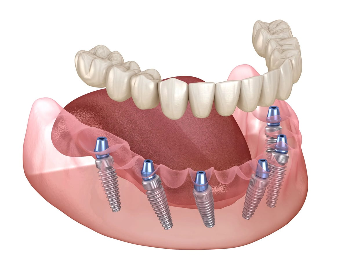 Full mouth implants