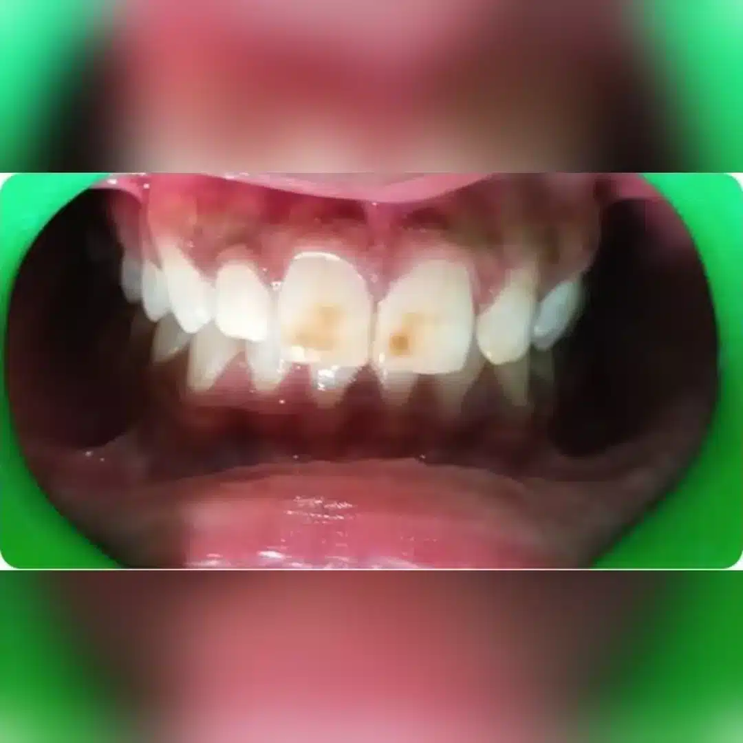 After dental implant result 3