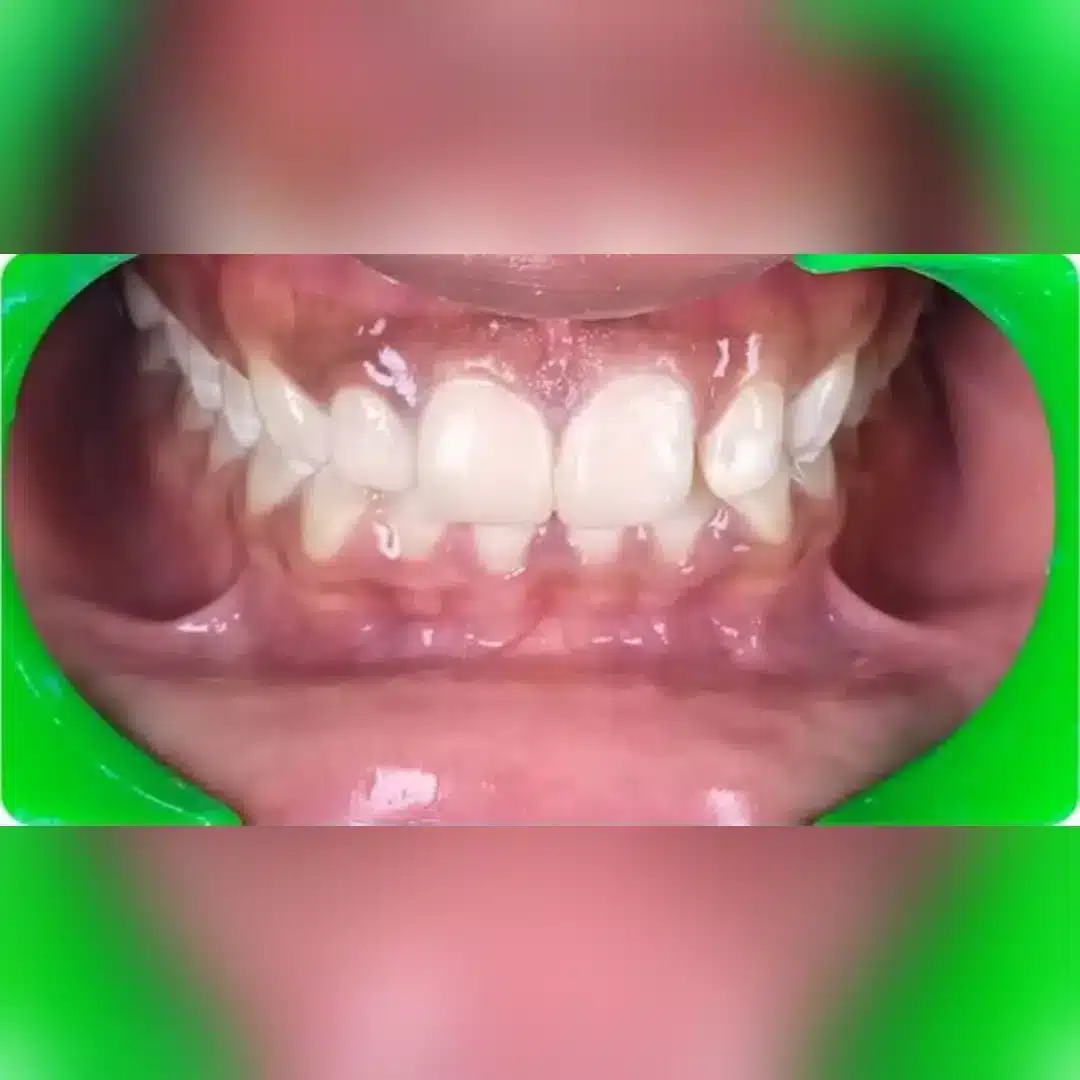 Before dental implant 2