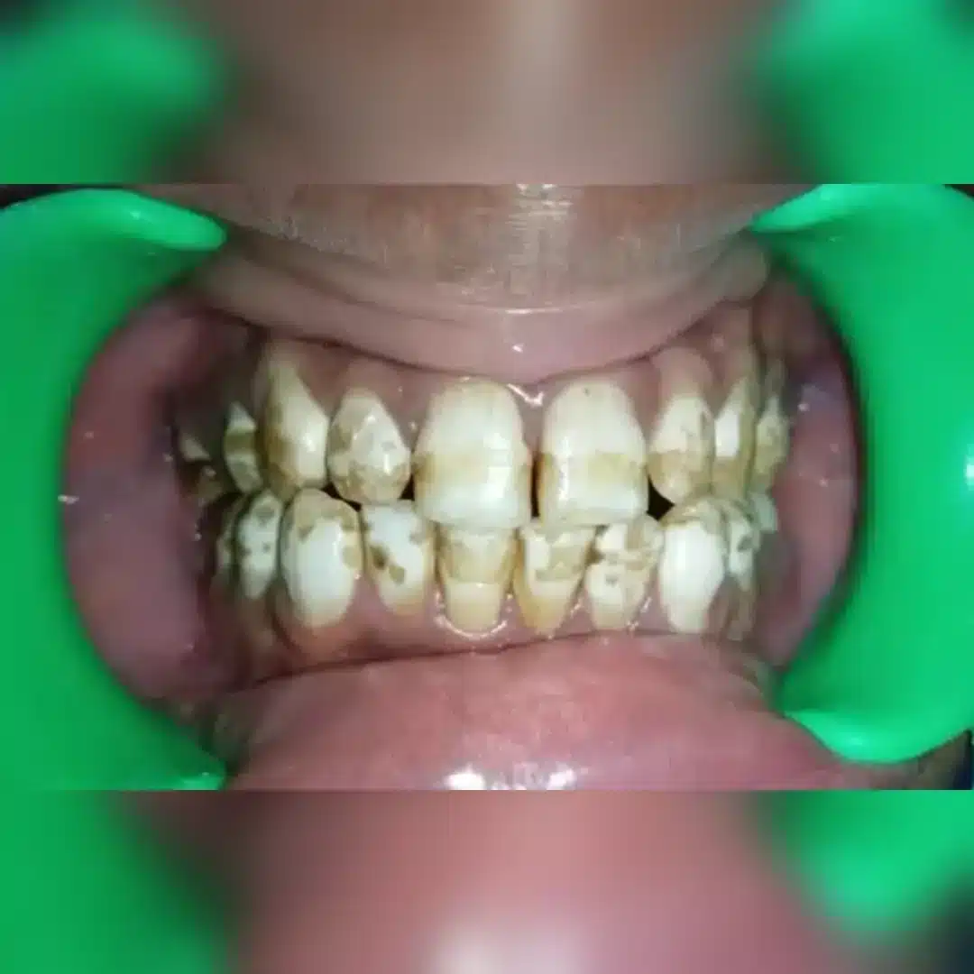 After dental implant result 2