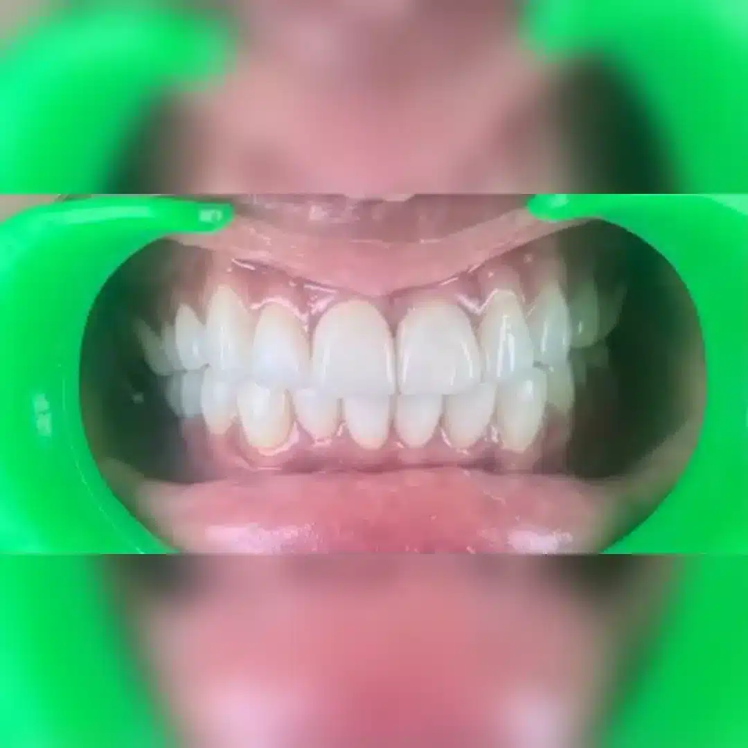 Before dental implant 3